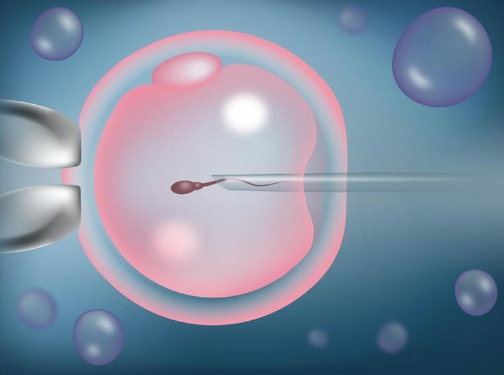 Intracytoplasmic Sperm Injection ICSI