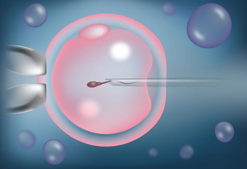 Intracytoplasmic Sperm Injection ICSI